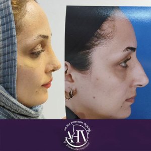 rhinoplasty23