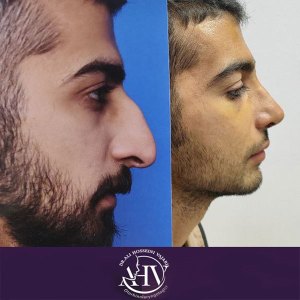 rhinoplasty24