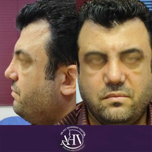 rhinoplasty25