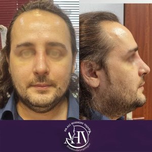 rhinoplasty26
