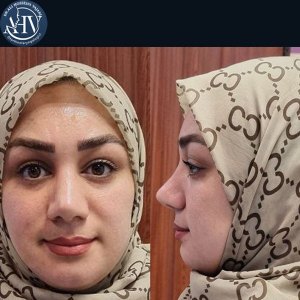 rhinoplasty27