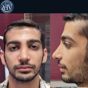 rhinoplasty28