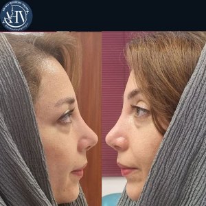 rhinoplasty29