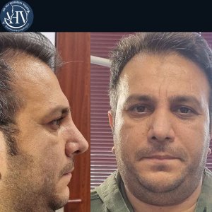 rhinoplasty30