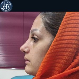 rhinoplasty31