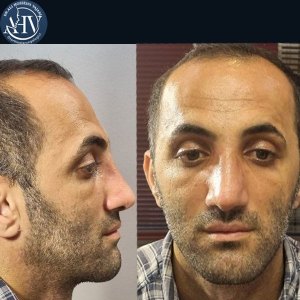 rhinoplasty32