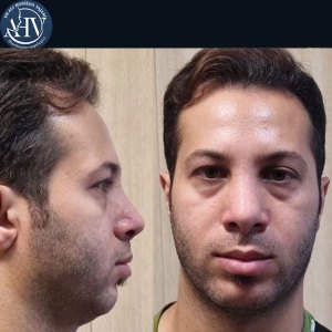 rhinoplasty33
