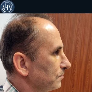 rhinoplasty34