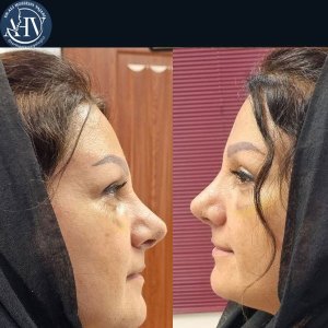 rhinoplasty35