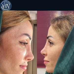 rhinoplasty36