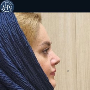 rhinoplasty37