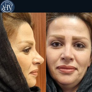 rhinoplasty38
