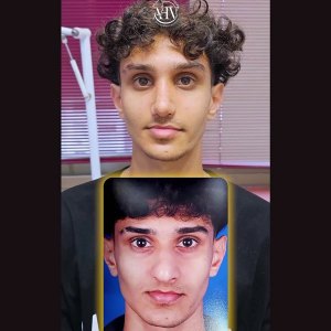 rhinoplasty41