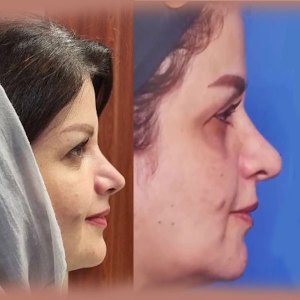 rhinoplasty42