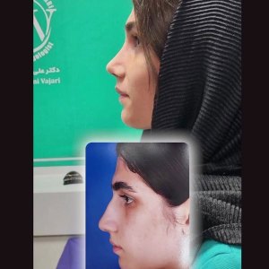 rhinoplasty43