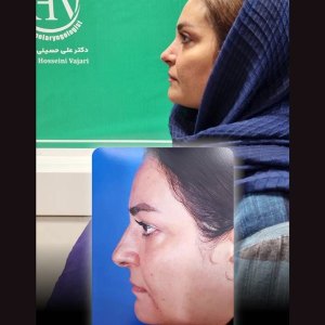 rhinoplasty44