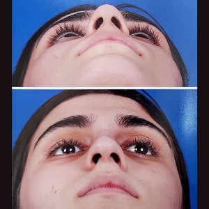 rhinoplasty45