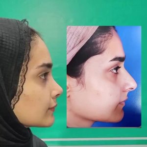 rhinoplasty46