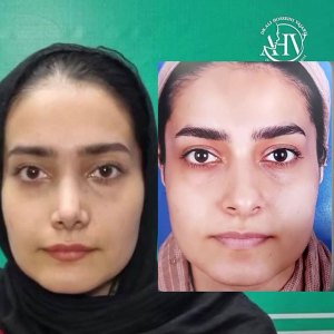 rhinoplasty47