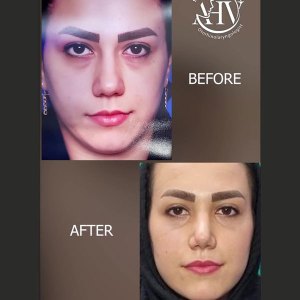 rhinoplasty48