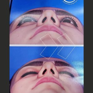 rhinoplasty49