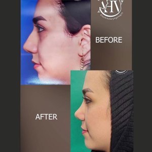 rhinoplasty50