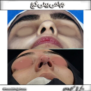 جراحی بینی کج