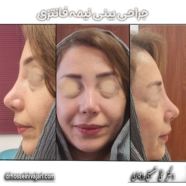 جراحی بینی نیمه فانتزی