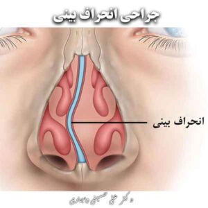 جراحی انحراف بینی