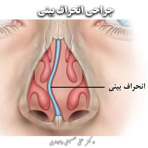 جراحی انحراف بینی