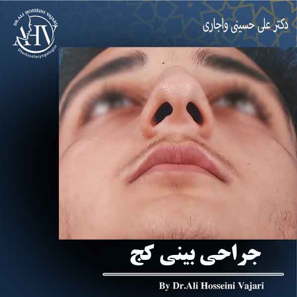 جراحی بینی کج