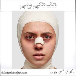 شکستگی بینی