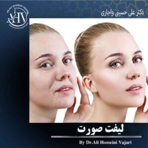لیفت صورت