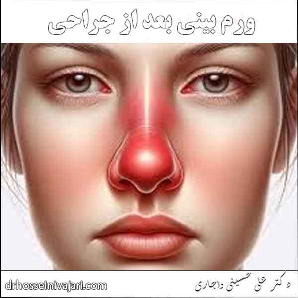 ورم بینی بعد از جراحی