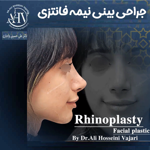 جراحی بینی نیمه فانتزی