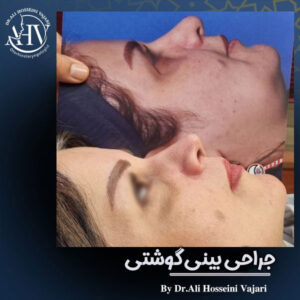 جراحی بینی گوشتی دکتر واجاری در رشت