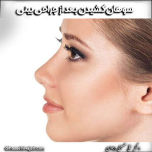 سوهان کشیدن بینی بعد از جراحی