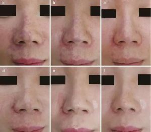 عکس واقعی نکروز بینی _ دکتر علی حسینی واجاری