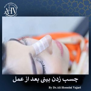 چسب زدن بینی بعد از عمل _ دکتر حسینی واجاری
