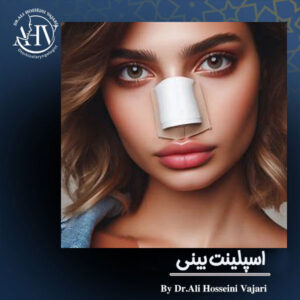 اسپلینت بینی