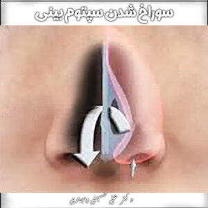 سوراخ شدن تیغه بینی