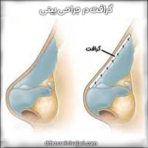 گرافت در جراحی بینی
