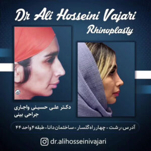 نمونه جراحی بینی دکتر علی حسینی واجاری در رشت