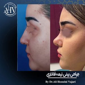 جراحی بینی نیمه فانتزی از دکتر علی حسینی واجاری در رشت
