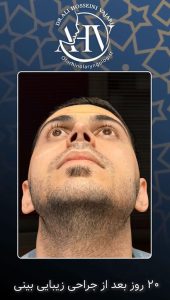 نمونه کار عمل بینی استخوانی _ دکتر حسینی واجاری