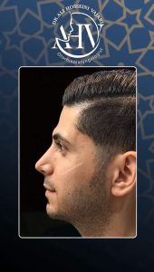 قبل و بعد عمل بینی استخوانی _ دکتر حسینی واجاری