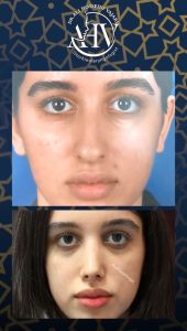 تصویر عمل بینی استخوانی _ دکتر علی حسینی واجاری