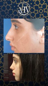 قبل و بعد جراحی بینی استخوانی _ دکتر حسینی واجاری