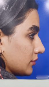 جراحی بینی گوشتی در رشت _ دکتر حسینی واجاری