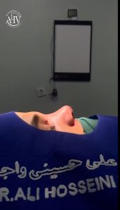 نتیجه عمل بینی گوشتی _ دکتر علی حسینی واجاری